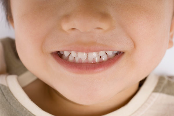 乳歯・永久歯の矯正