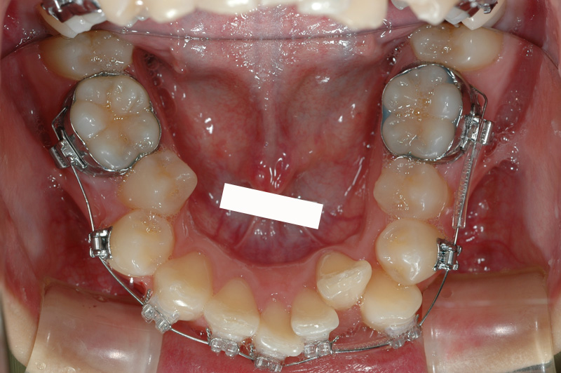 見えない矯正症例歯の裏側矯正01下